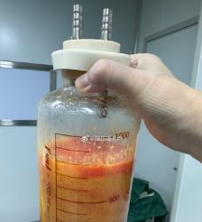 宁波水动力吸脂手术要做多久？